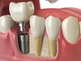 Dental implants treatment