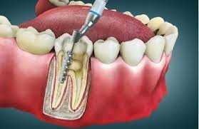 Root Canal Treatment dental care