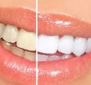 Teeth cleaning and whitening dental care